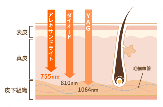ソプラノチタニウムのレーザーの解説画像
